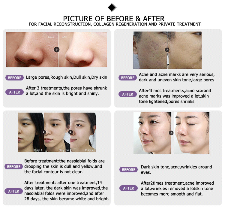 10600nm lumenis ultrapulse co2 laser machine for skin resurfacing