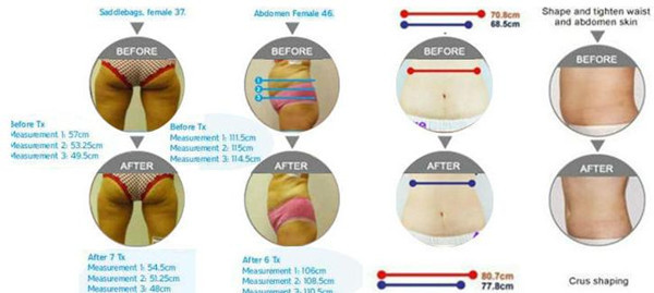 Non-Surgical Cryolipolysis Slimming Beauty machine_