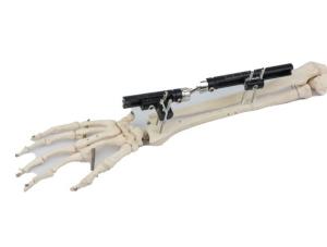 Sterilized Bone Fracture Distal Radius External Fixator