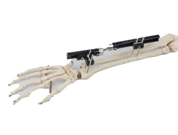 Quality Sterilized Bone Fracture Distal Radius External Fixator for sale
