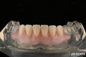 Personalized Invisible Denture Finished With Advanced Tooth Arrangement Technology