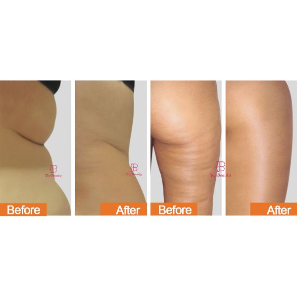 R- Sleek Roller Muscle Massager Therapy Slimming Machine