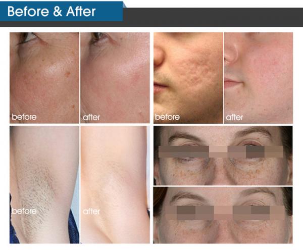 Opt E Light Ipl Laser Beauty Equipment Dpl Body Women Man Skin Facial Hair Removal Device