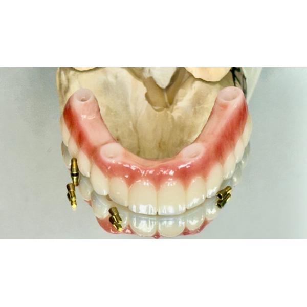 Dental All On X Implant PFM Crown Titanium Fixed Hybrid Denture