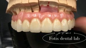 Reliable Restoration PFM Dental Crowns Porcelain Fused To Metal Crown Customized