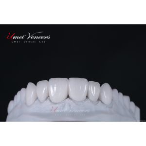 Durable whitening veneer for teeth
