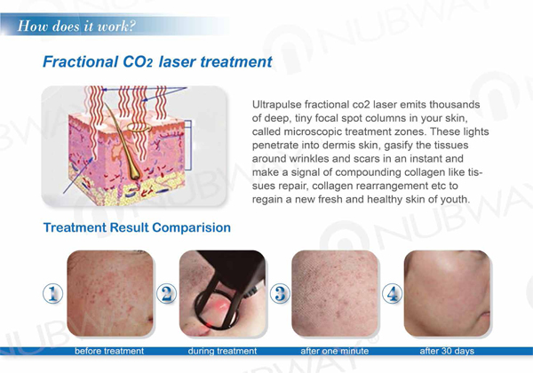Best skin resurfacing acne scars anti aging treatments rf fractional co2 laser