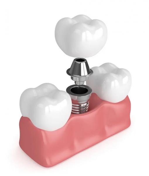 Quality True Dentures Implants Single All Ceramic Dentures Missing Teeth Fillings for sale