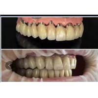 Dental implants Telescope PFM porcelain bridge for sale