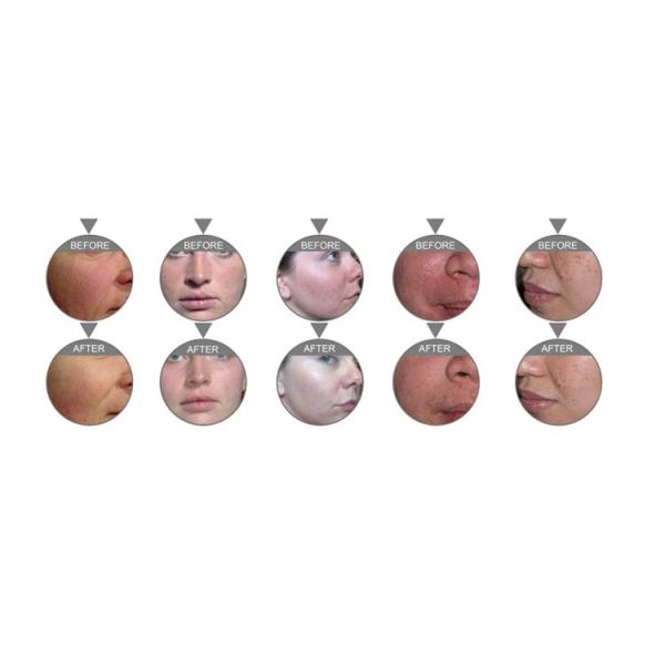 Portable Deep Cleaning Water Oxygen Jet Peel Machine 6" Color Touch Screen