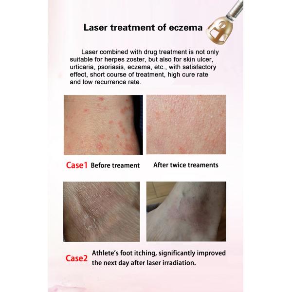 980nm Nail Fungus Removal Laser Machine Non Invasive Type Laser Treatment For Nail