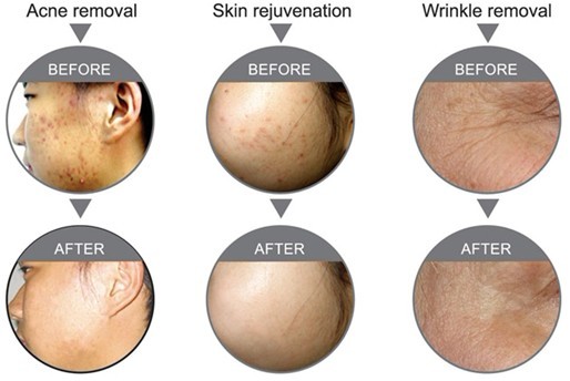 Red Light LED PDT Skin Rejuvenation