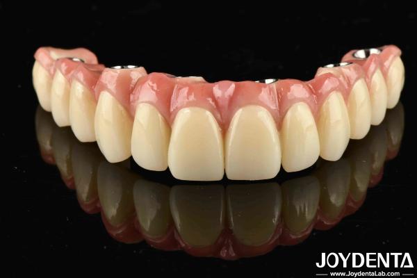 Quality Low Density Light Weight Comfortable To Wear Titanium Malong Hybrid Bridge For Long-Lasting Performance for sale
