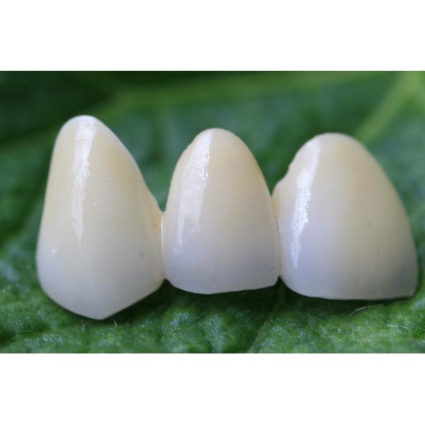 Natural EMAX Dental Crown
