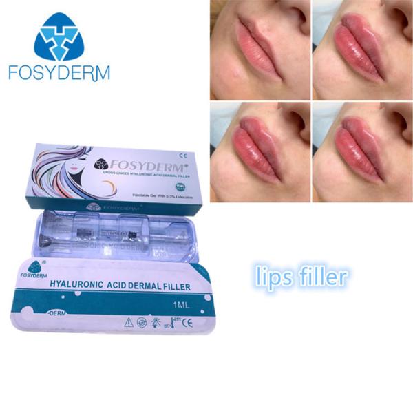 Quality Filling Face Injection Fosyderm Fosyderm Hyaluronic Acid Lip Fillers 1ml for sale