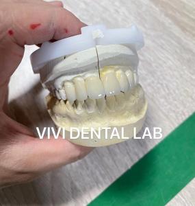 Wafer Thin Dental Emax Laminate Veneers Translucency Porcelain