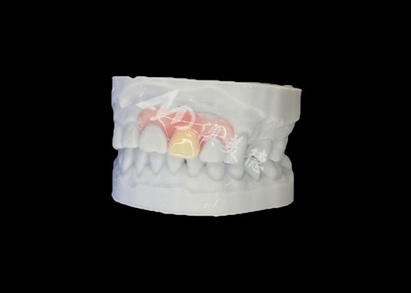 Customized Nesbit Flexible Partial Denture for Natural Fit and Longlasting