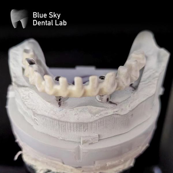 Customizable Industrial Malo Bridge In Silver And Gold Malo Implant Bridge