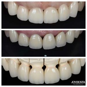 Excellent Biocompatibility Dental Porcelain Veneers No Need For Preparation Process