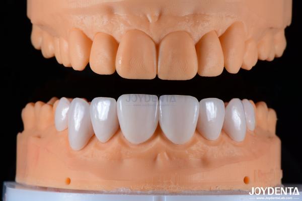 Quality Secure Fit Porcelain Veneers Ceramic and Natural Aesthetics with Strong Adhesion for sale