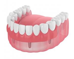 Dentures Missing Teeth Dental Implant Bar Fillings Dentures Temporary Removable Dentures