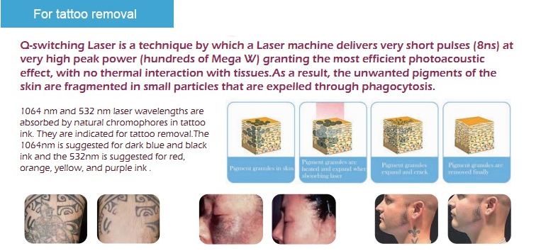 New model birth mark long pulse tattoo removal q switch laser for hyperpigmentation