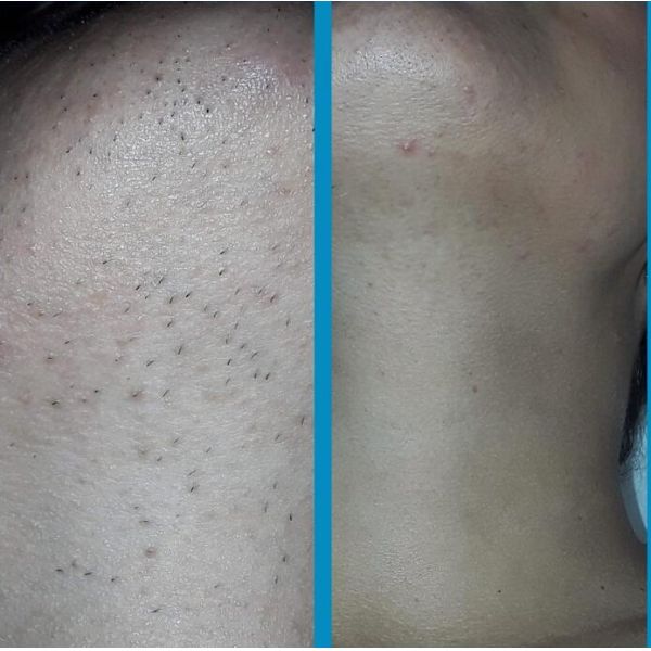 Portable Triple Wavelength Diode Laser Machine For Hair Removal