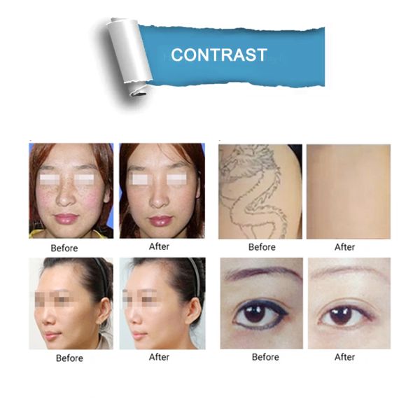 SP1multifunctional skin tightening Q Switched Laser Beauty Machine new technologies Co2 fractional laser pigment removal