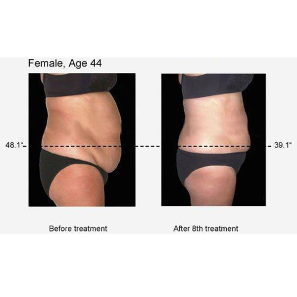 5MHz Multipolar RF Radio Frequency Fat Reduction Machine Better For Whiten Skin