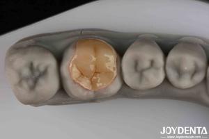 Resistant To Wear And Tear Good Transparency Low Strength Emax Inlay Onlay For Your Operational Efficiency