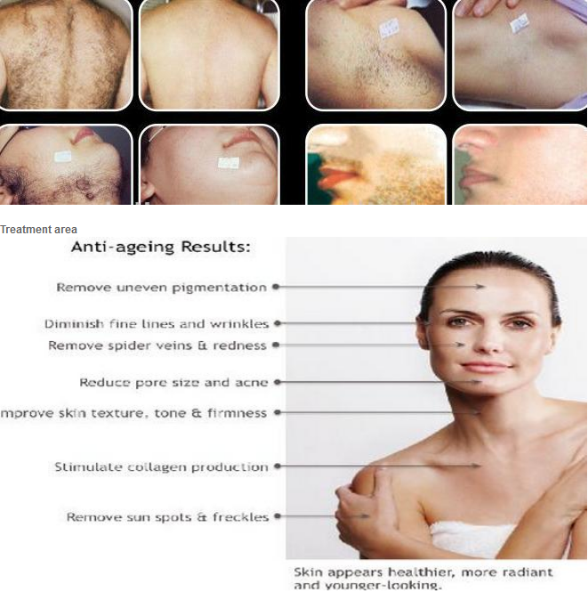 new product on market!!! Advanced e-light shr ipl machine