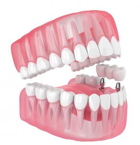 China Single All Ceramic Teeth Dental Implants Missing Filling Dentures Wisdom Teeth wholesale