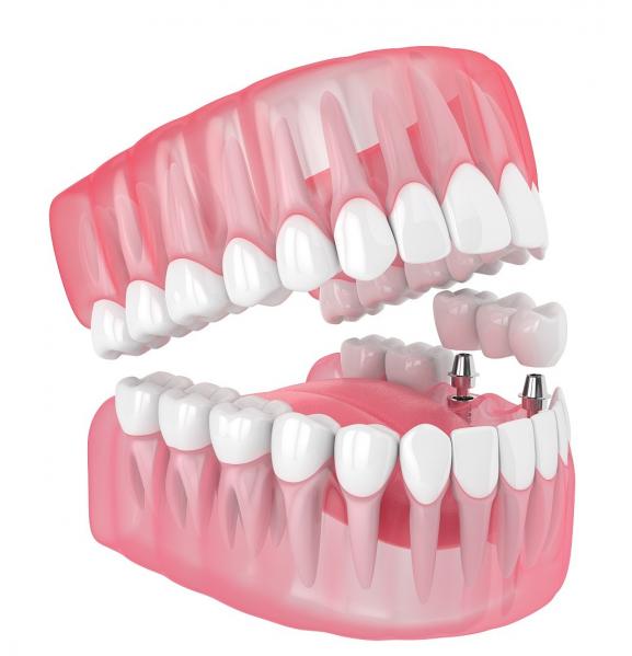 Quality Single All Ceramic Teeth Dental Implants Missing Filling Dentures Wisdom Teeth for sale