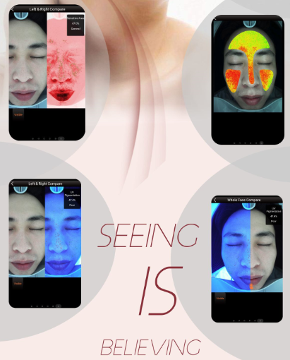 Medical Skin Analysis Machine Therapist Dermis Layer Detect 10 years Experience