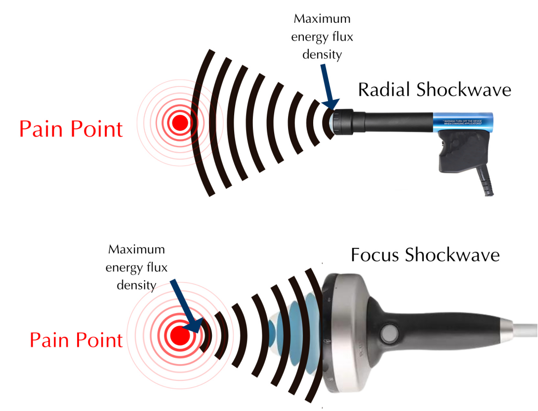 Ballistic Principle Shockwave Therapy Machine with 6 Different Preload Modes