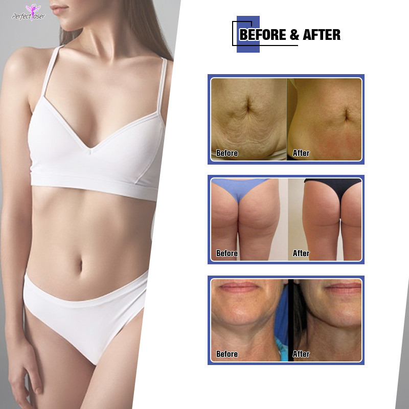 Professional Effective 20W Laser Slimming Machine 850VA Input Power 40KHz Cavitation