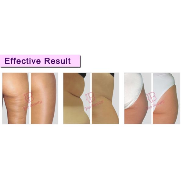 Therapy Machine Beauty Salon Vacuum System Roller Massage Anti Cellulite Vacuum Roller Rf Machine